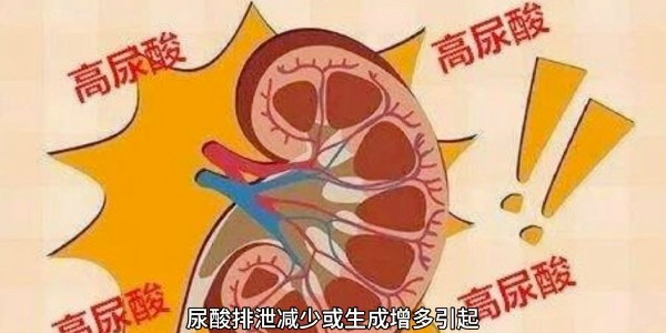 突然痛風？別再只怪啤酒和燒烤！真正的“尿酸元兇”遠比你想的多！
